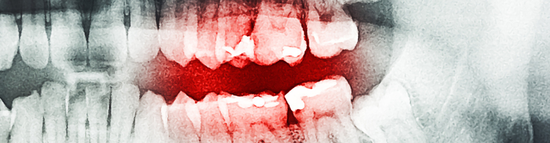 Dental X-ray showing teeth with fillings.